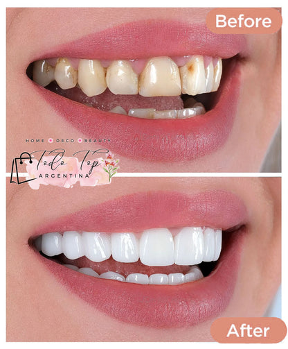 Blanqueador Dental USB – Sonríe con Confianza y Brillo Profesional